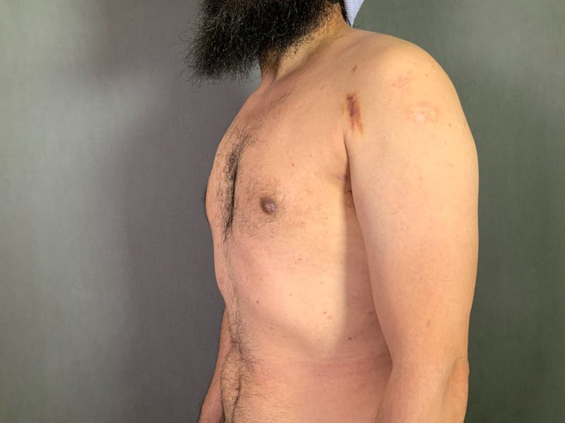 Gynecomastia Before & After Gallery - Patient 167388065 - Image 4