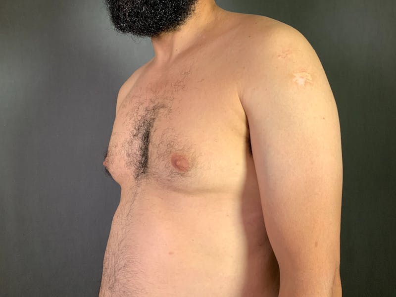 Gynecomastia Before & After Gallery - Patient 167388065 - Image 3