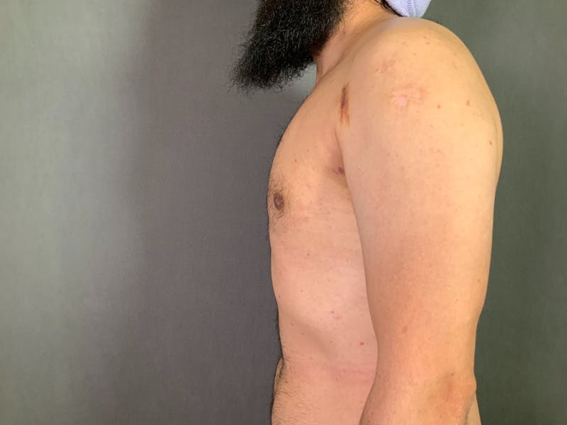 Gynecomastia Before & After Gallery - Patient 167388065 - Image 6