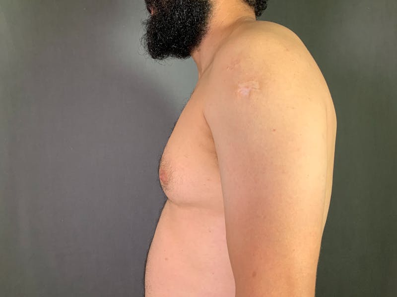 Gynecomastia Before & After Gallery - Patient 167388065 - Image 5