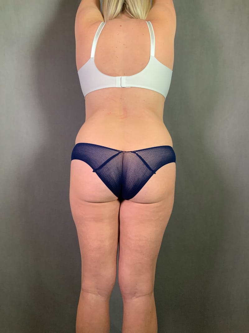 Liposuction Before & After Gallery - Patient 167388269 - Image 1