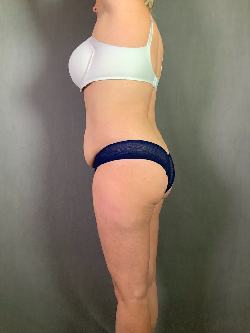 Liposuction Before & After Gallery - Patient 167388269 - Image 3