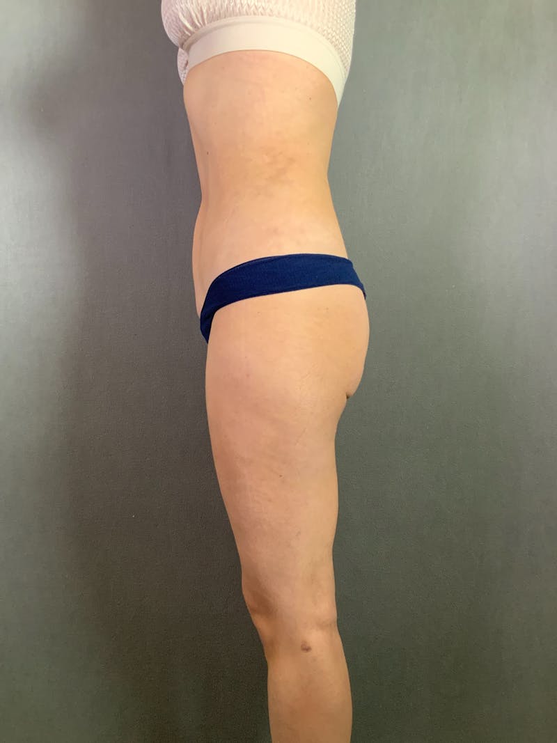 Liposuction Before & After Gallery - Patient 167389506 - Image 8
