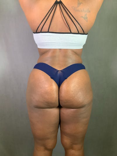 Liposuction Before & After Gallery - Patient 167389727 - Image 2