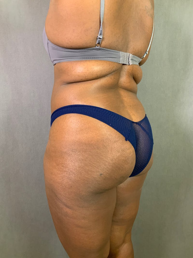 Liposuction Before & After Gallery - Patient 167389727 - Image 3