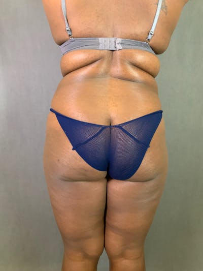 Liposuction Before & After Gallery - Patient 167389727 - Image 1