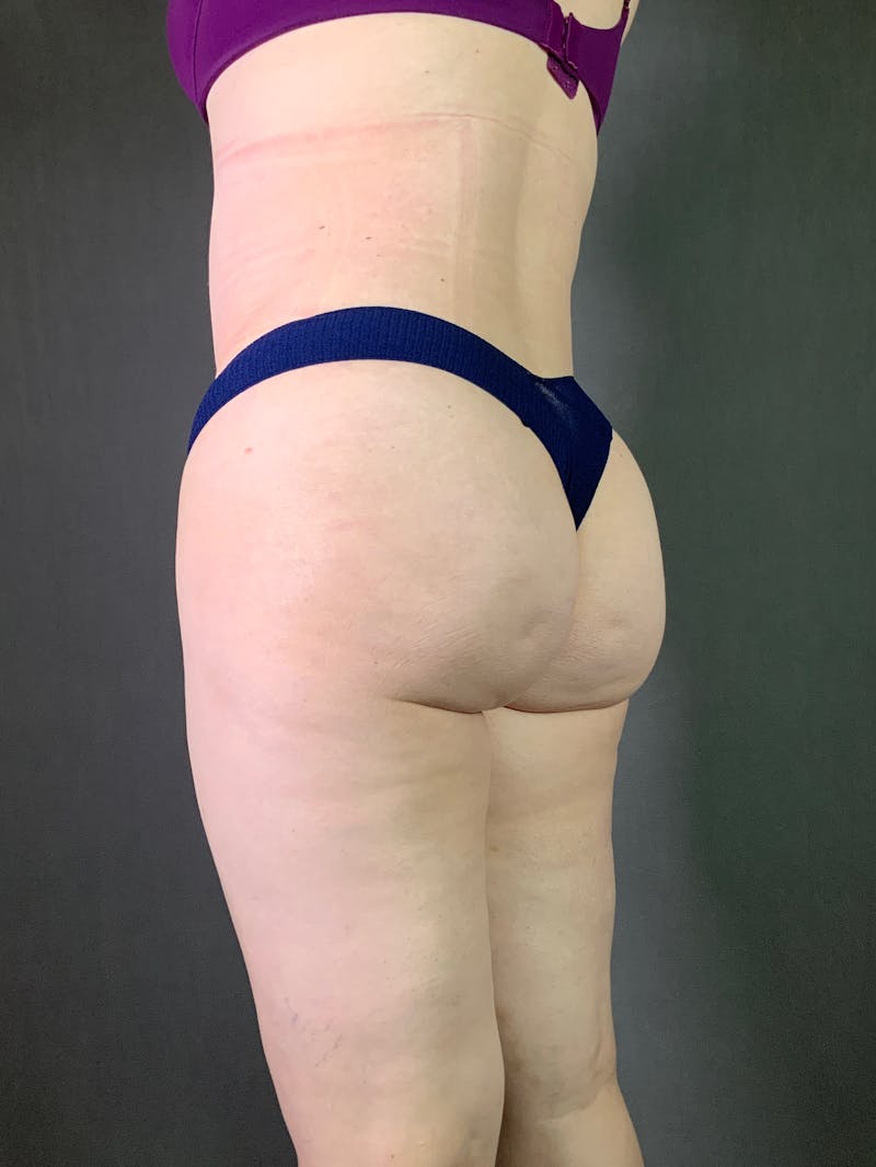 Liposuction Before & After Gallery - Patient 167389788 - Image 4