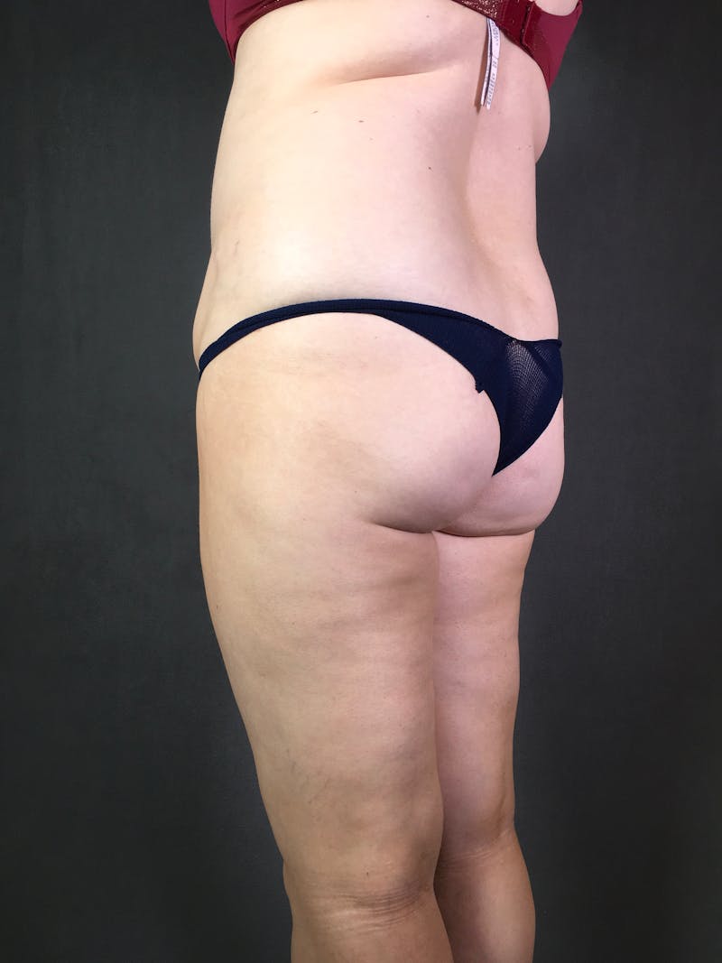 Liposuction Before & After Gallery - Patient 167389788 - Image 3