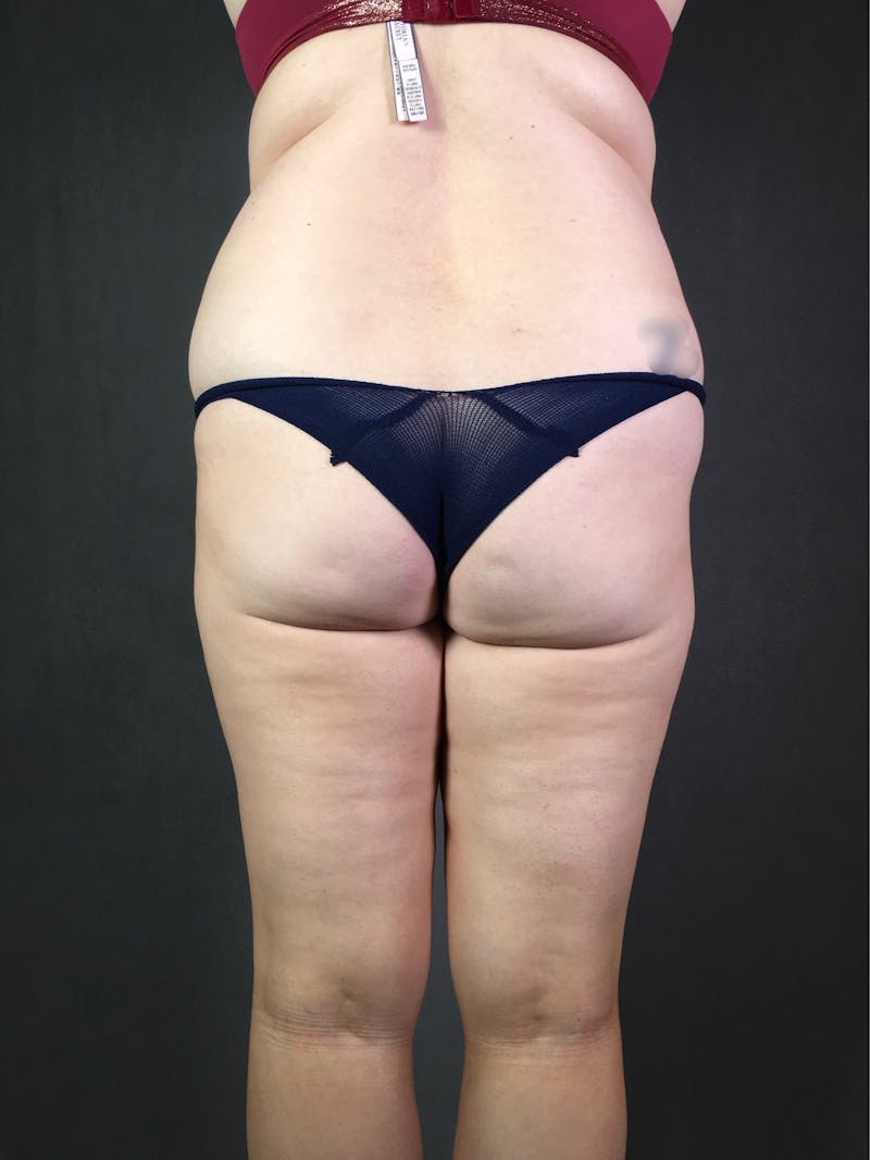 Liposuction Before & After Gallery - Patient 167389788 - Image 1