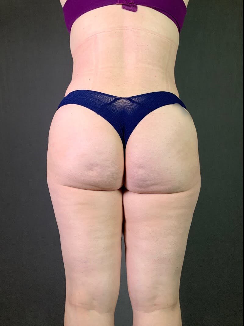 Liposuction Before & After Gallery - Patient 167389788 - Image 2