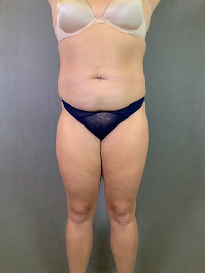 Liposuction Before & After Gallery - Patient 167389835 - Image 1