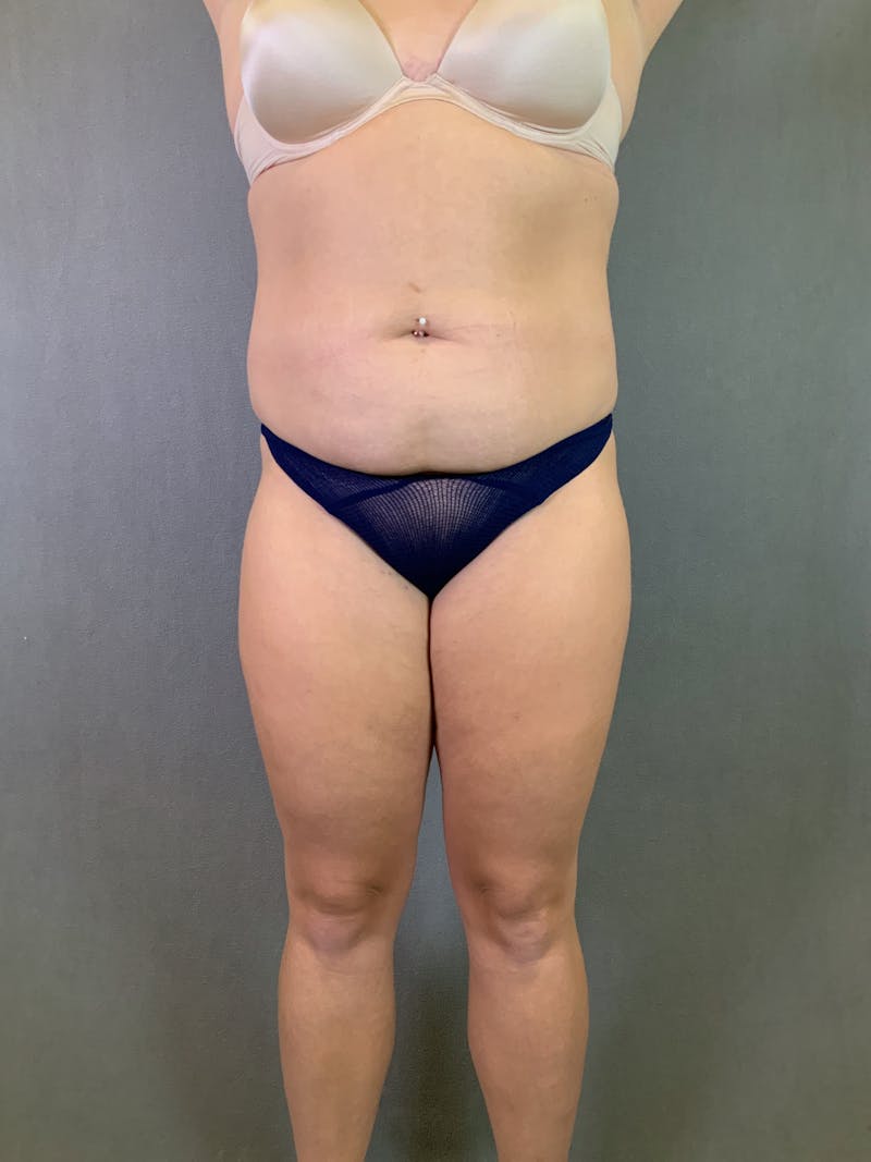 Liposuction Before & After Gallery - Patient 167389835 - Image 1