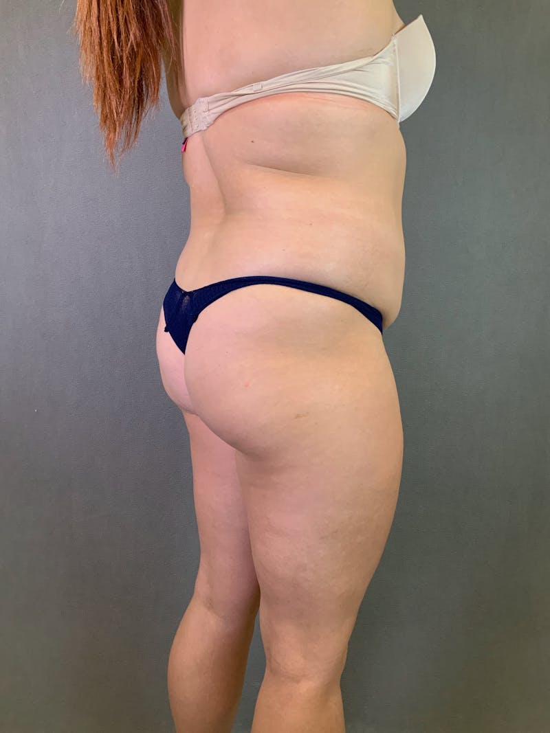 Liposuction Before & After Gallery - Patient 167389835 - Image 7