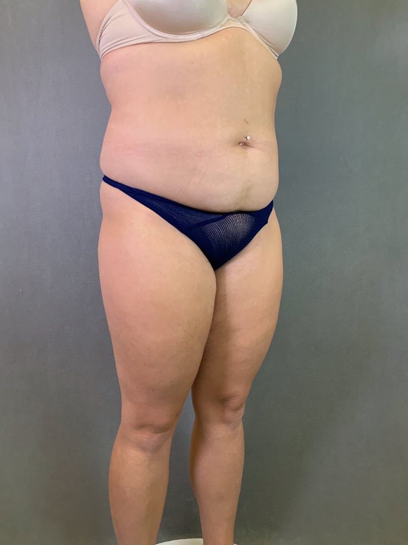 Liposuction Before & After Gallery - Patient 167389835 - Image 3