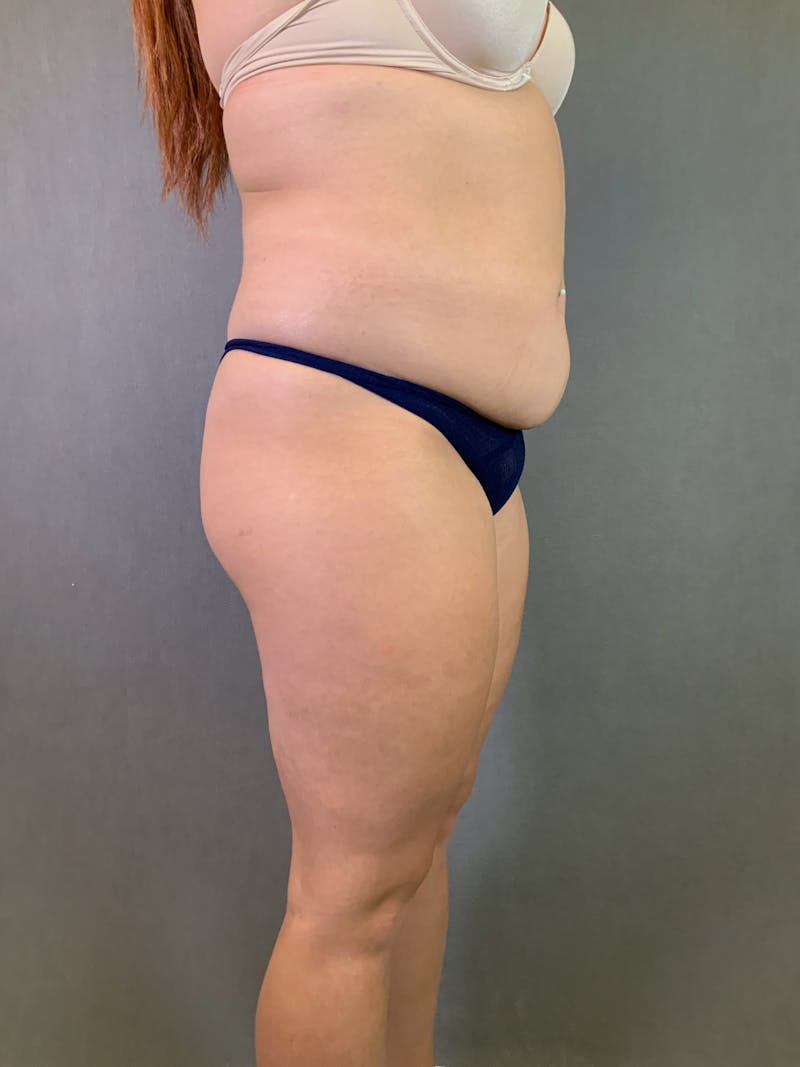Liposuction Before & After Gallery - Patient 167389835 - Image 5