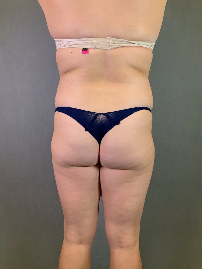 Liposuction Before & After Gallery - Patient 167389835 - Image 9