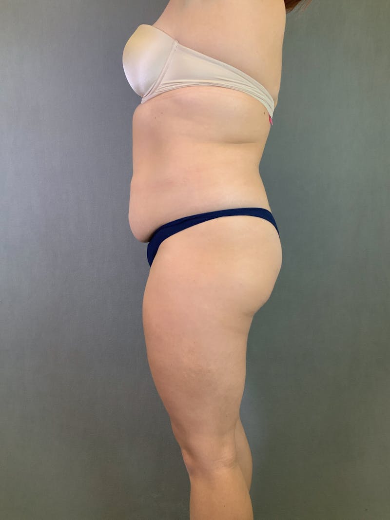 Liposuction Before & After Gallery - Patient 167389835 - Image 13