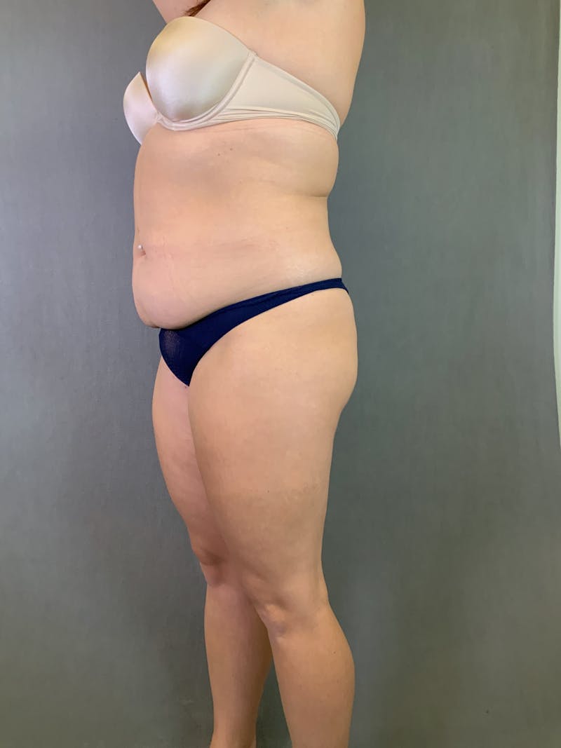 Liposuction Before & After Gallery - Patient 167389835 - Image 15