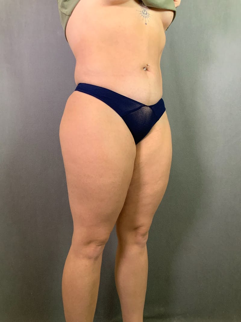 Liposuction Before & After Gallery - Patient 167389835 - Image 4