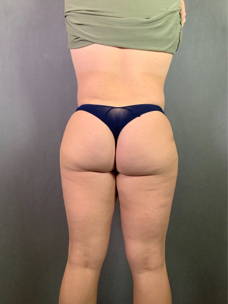 Liposuction Before & After Gallery - Patient 167389835 - Image 10
