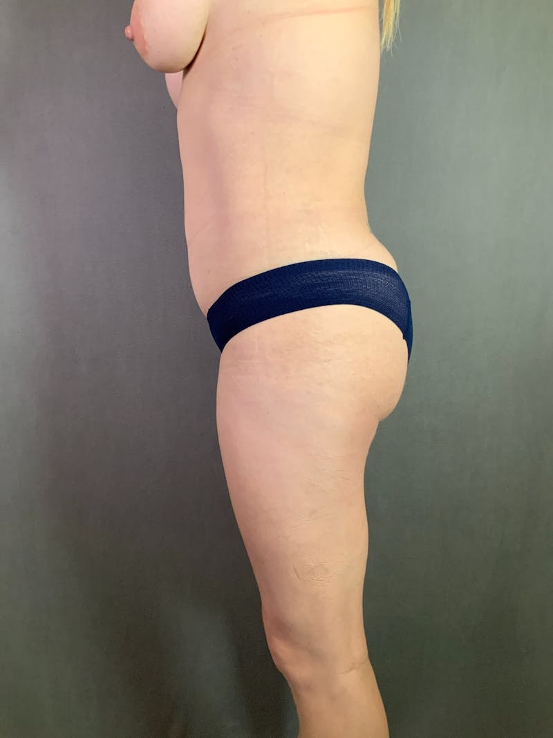 Liposuction Before & After Gallery - Patient 167390503 - Image 6