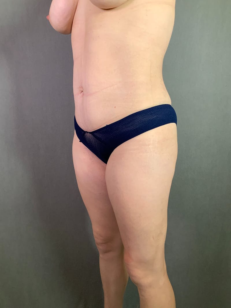 Liposuction Before & After Gallery - Patient 167390503 - Image 8