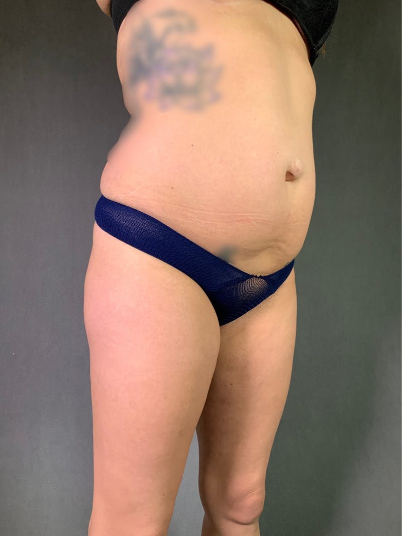 Liposuction Before & After Gallery - Patient 167390503 - Image 11