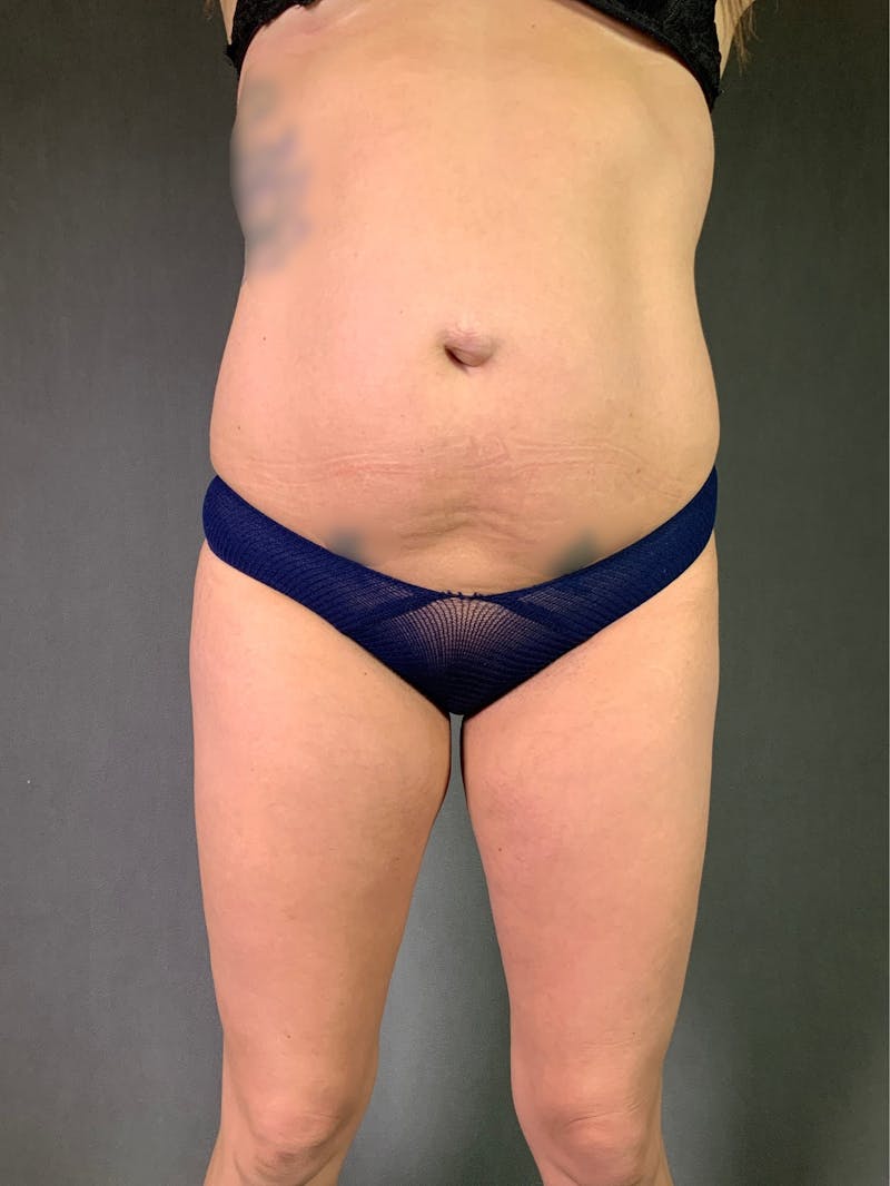 Liposuction Before & After Gallery - Patient 167390503 - Image 1