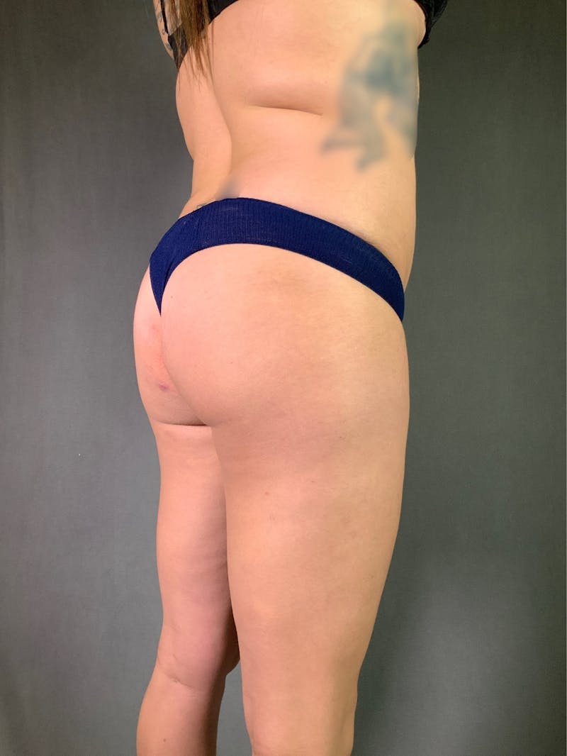 Liposuction Before & After Gallery - Patient 167390503 - Image 15