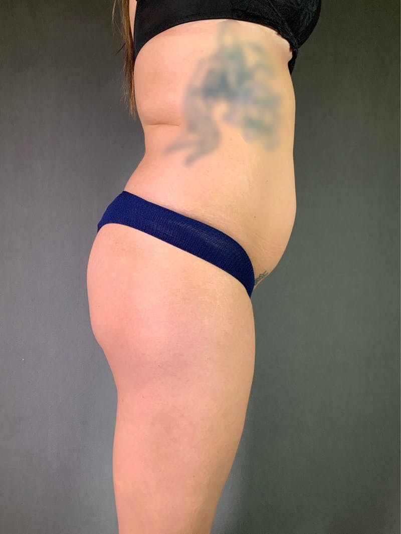 Liposuction Before & After Gallery - Patient 167390503 - Image 13