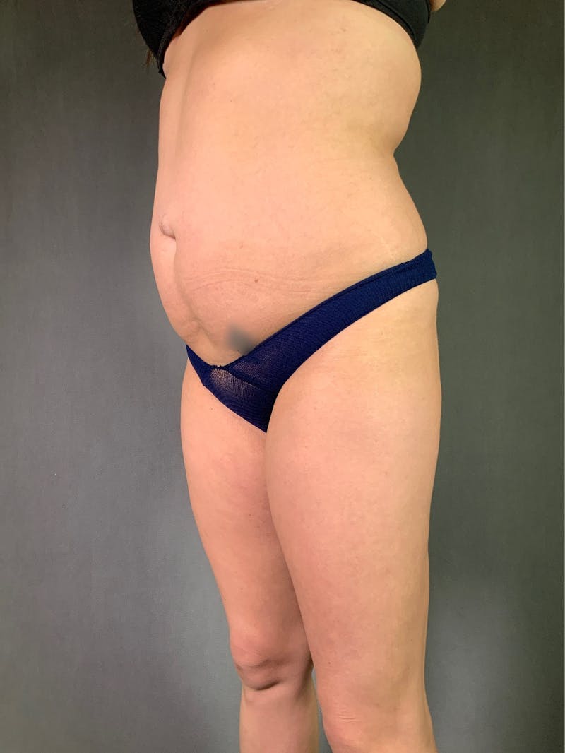 Liposuction Before & After Gallery - Patient 167390503 - Image 7