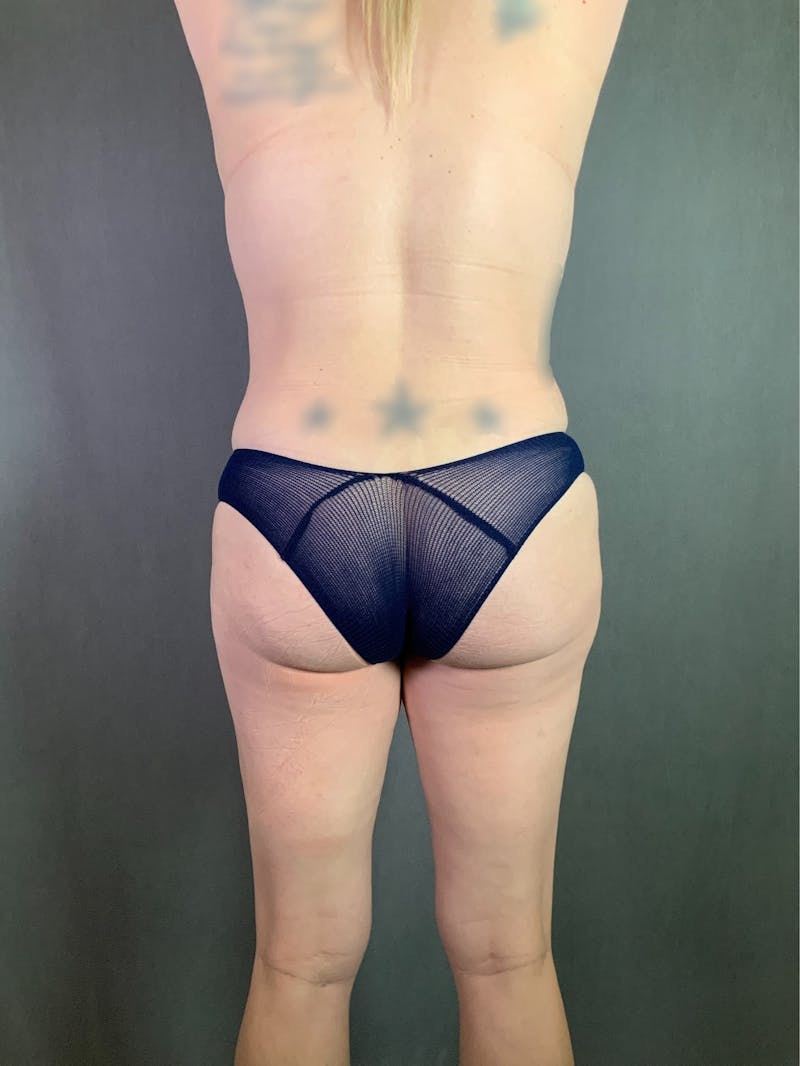 Liposuction Before & After Gallery - Patient 167390503 - Image 10