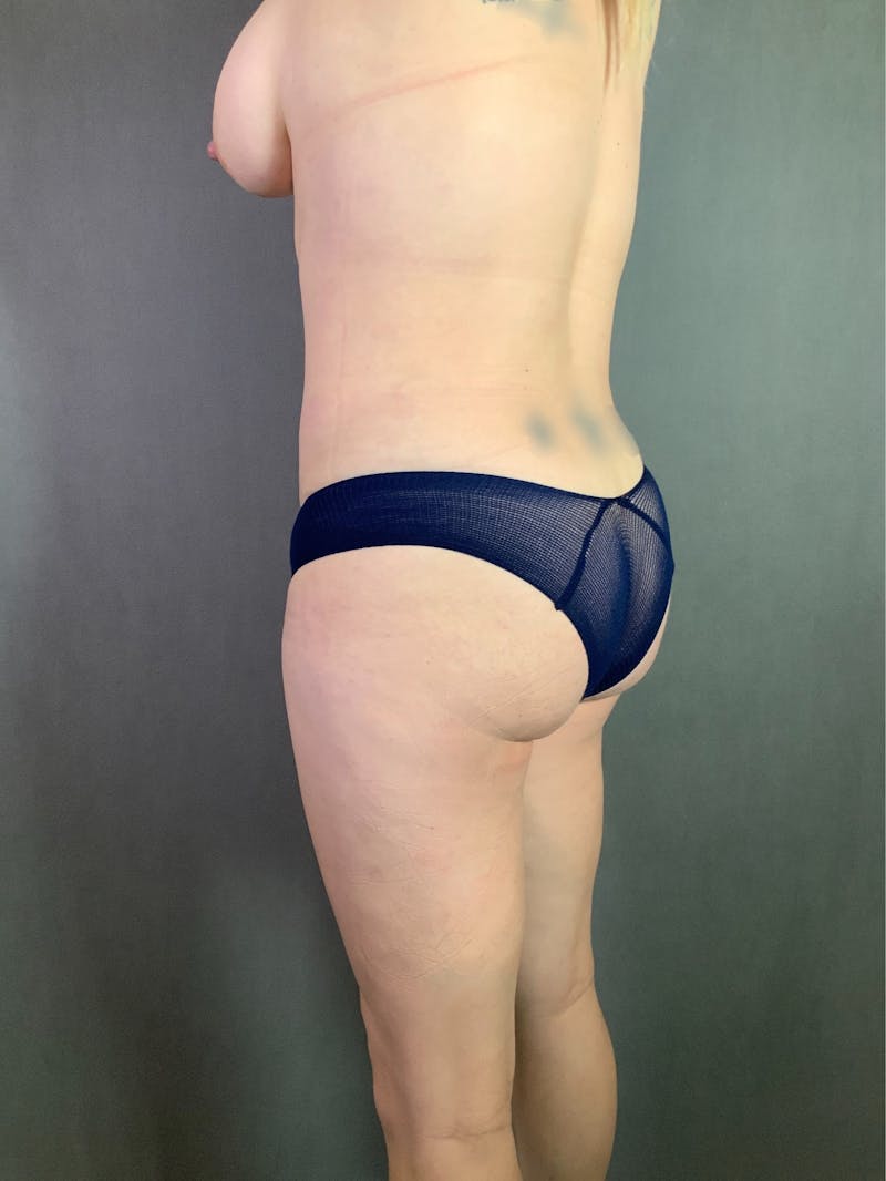 Liposuction Before & After Gallery - Patient 167390503 - Image 4