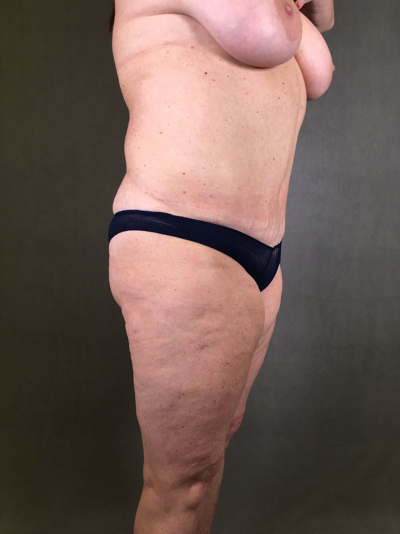 Liposuction Before & After Gallery - Patient 167391129 - Image 3