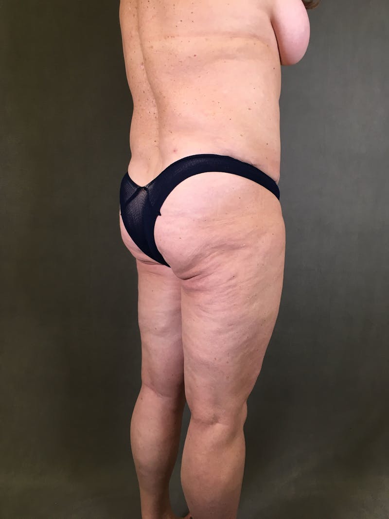 Liposuction Before & After Gallery - Patient 167391129 - Image 5