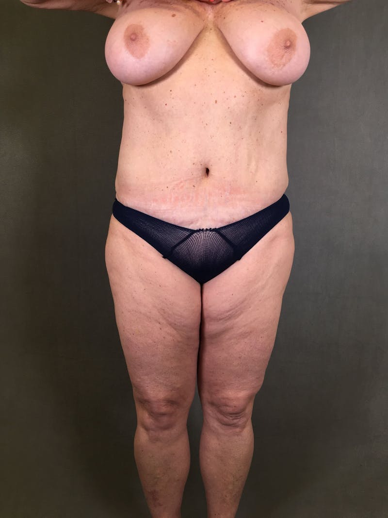 Liposuction Before & After Gallery - Patient 167391129 - Image 1