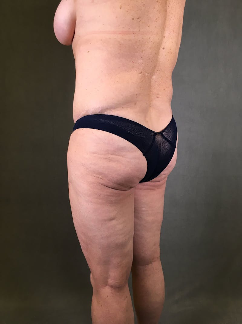 Liposuction Before & After Gallery - Patient 167391129 - Image 9