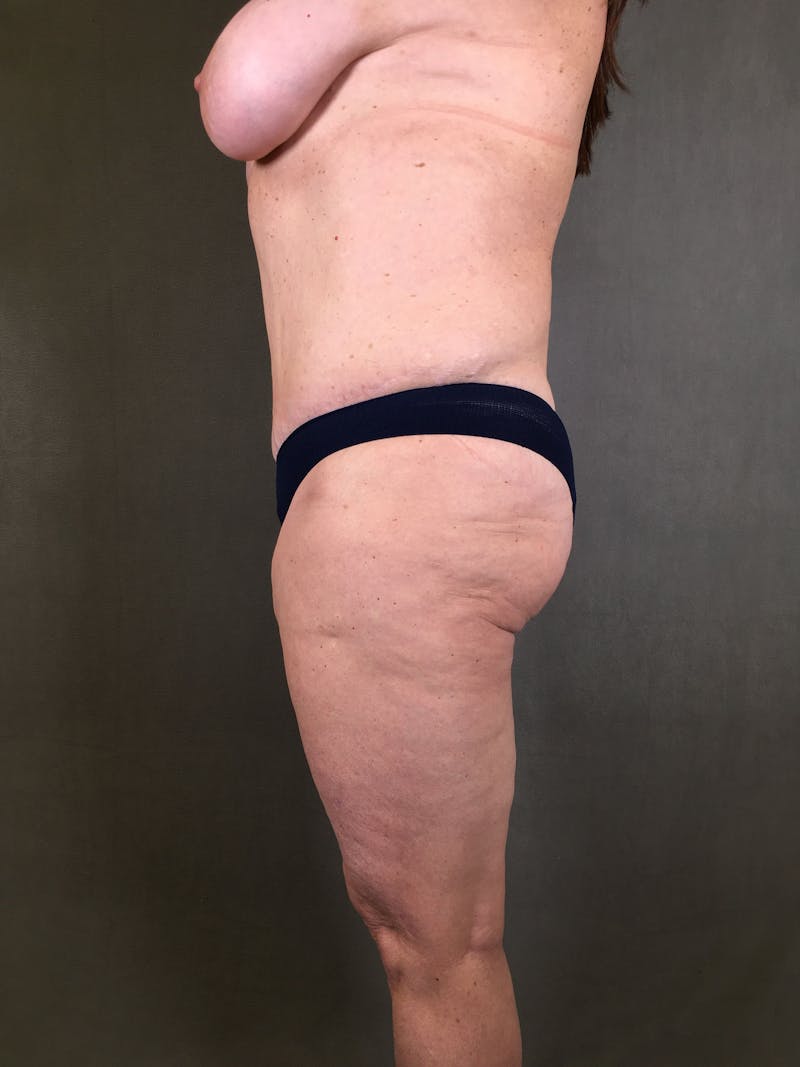 Liposuction Before & After Gallery - Patient 167391129 - Image 11