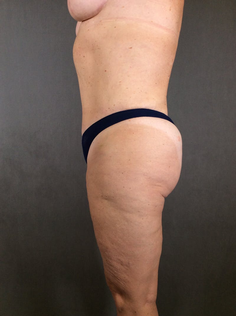 Liposuction Before & After Gallery - Patient 167391129 - Image 12