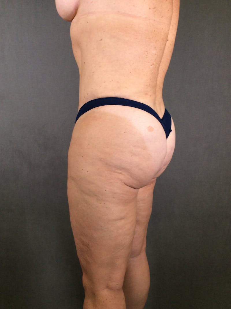 Liposuction Before & After Gallery - Patient 167391129 - Image 10