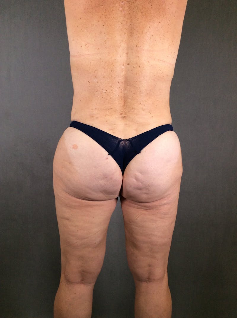 Liposuction Before & After Gallery - Patient 167391129 - Image 8