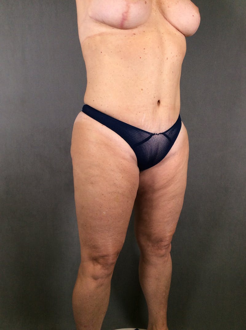 Liposuction Before & After Gallery - Patient 167391129 - Image 4