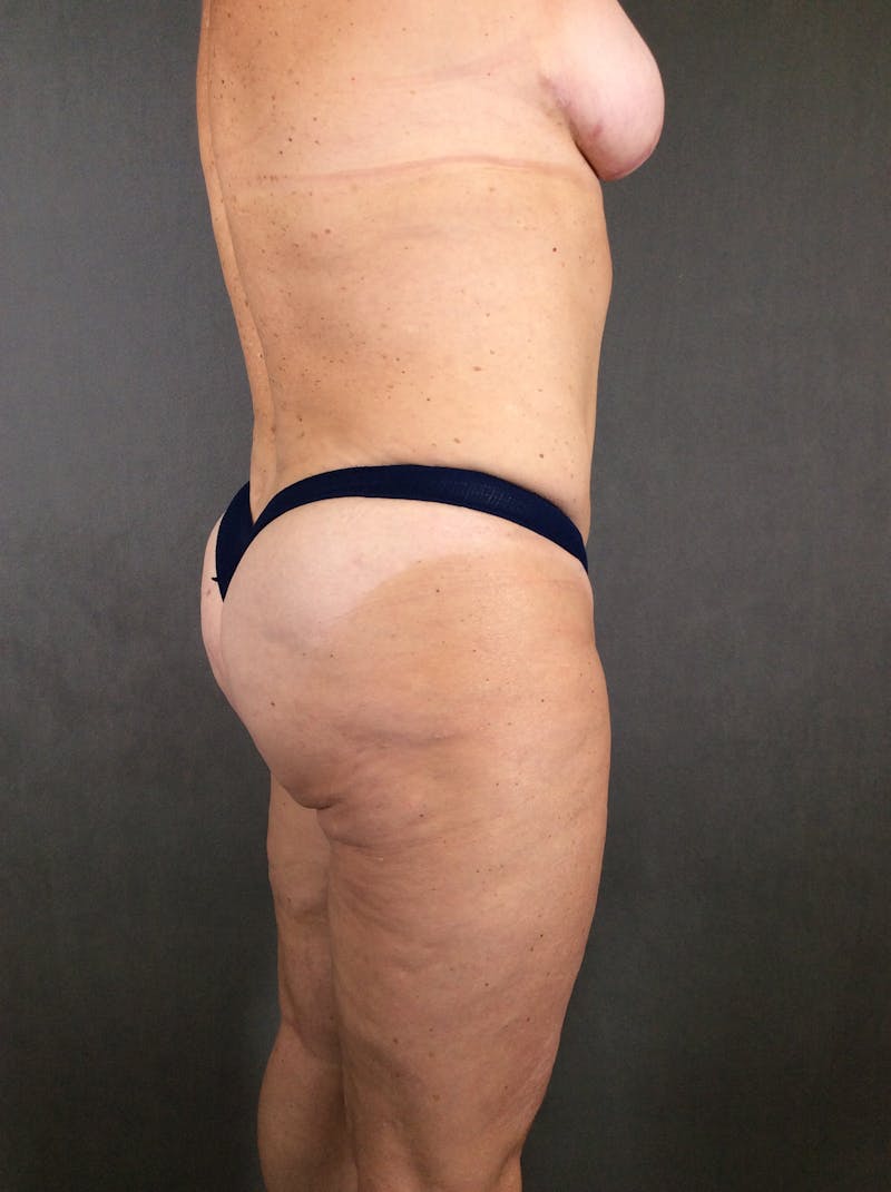 Liposuction Before & After Gallery - Patient 167391129 - Image 6