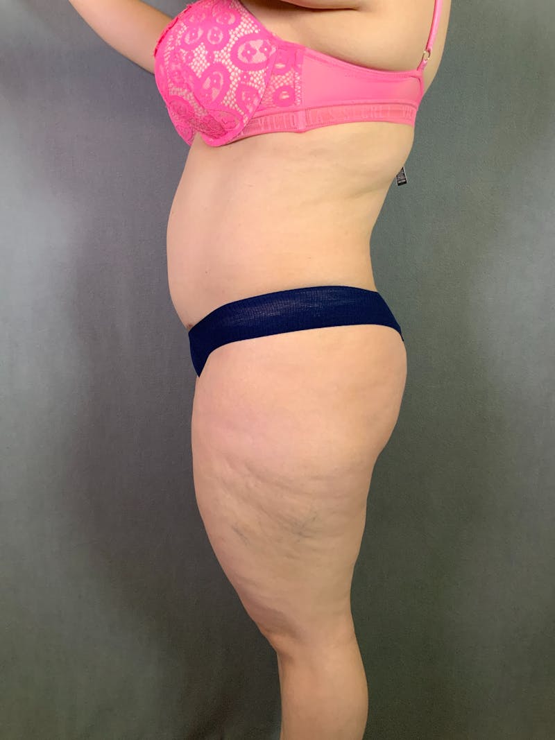 Liposuction Before & After Gallery - Patient 167391182 - Image 5