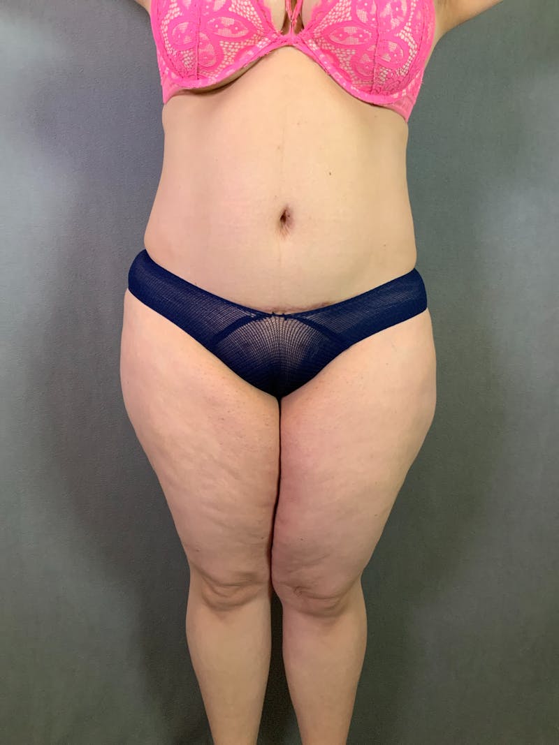 Liposuction Before & After Gallery - Patient 167391182 - Image 1
