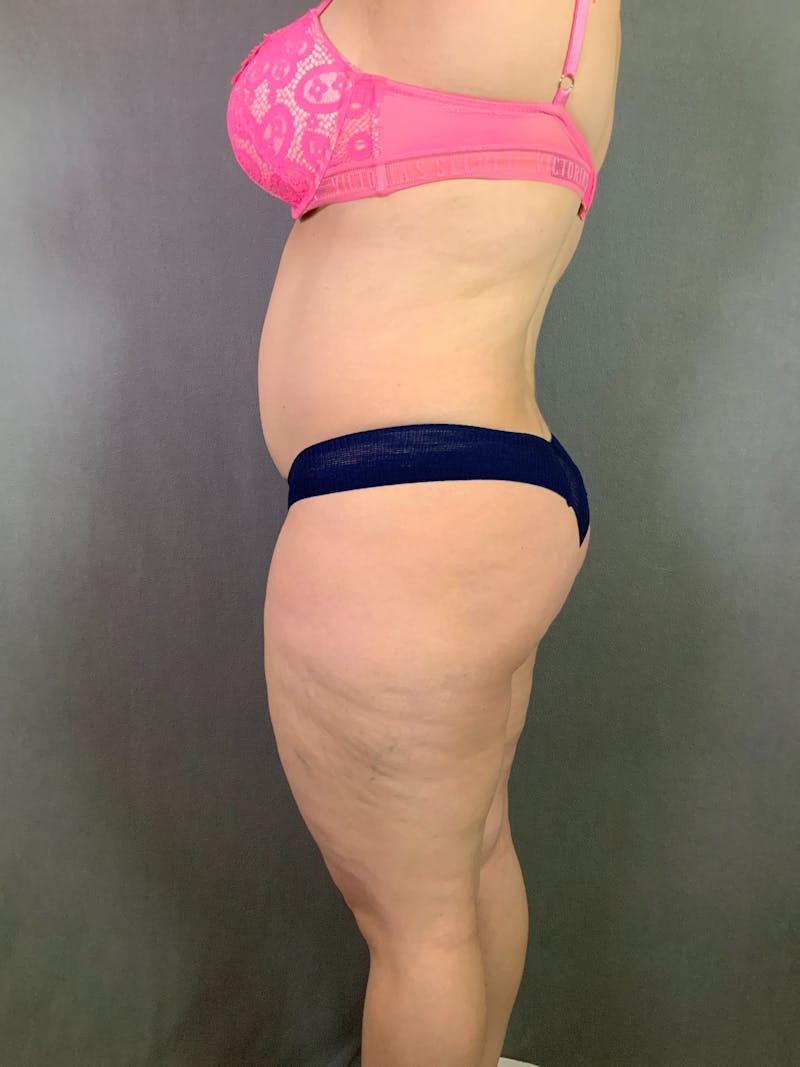 Liposuction Before & After Gallery - Patient 167391182 - Image 7