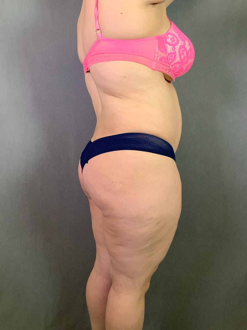 Liposuction Before & After Gallery - Patient 167391182 - Image 11