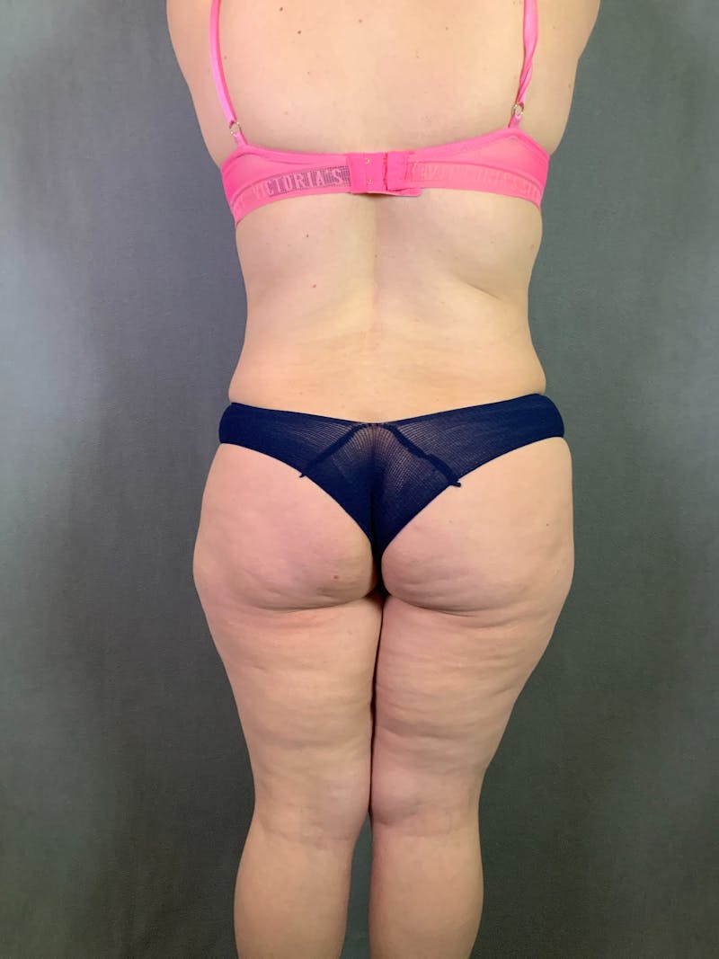 Liposuction Before & After Gallery - Patient 167391182 - Image 15