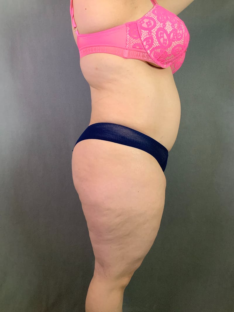 Liposuction Before & After Gallery - Patient 167391182 - Image 13