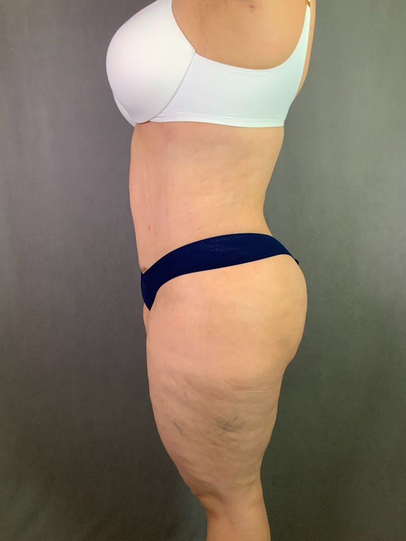 Liposuction Before & After Gallery - Patient 167391182 - Image 6